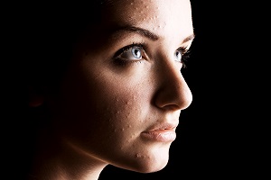 acne in Coraopolis, PA and Pittsburgh, PA